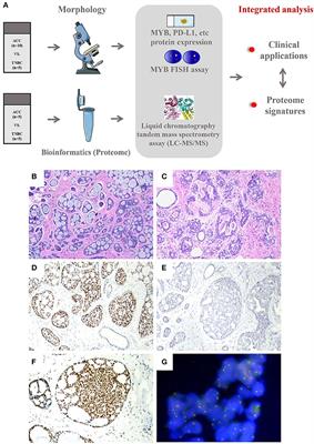 Comparative proteomic and clinicopathological analysis of breast adenoid cystic carcinoma and basal-like triple-negative breast cancer